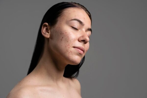 Melhores Cidos Para Manchas De Acne