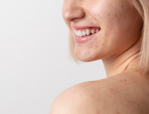 Recupere a Confiança com Tratamentos Eficazes Contra Acne