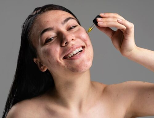 Descubra os Segredos dos Tratamentos Eficientes contra a Acne