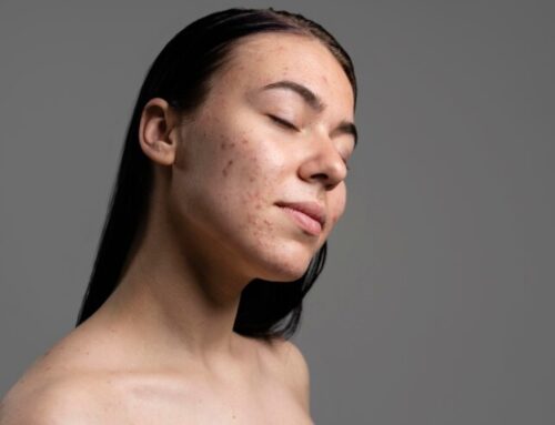 Melhores Ácidos para Manchas de Acne